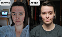 Mild Cystic acne  - before - after 4 weeks