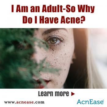I Am an Adult-So Why Do I Have Acne?