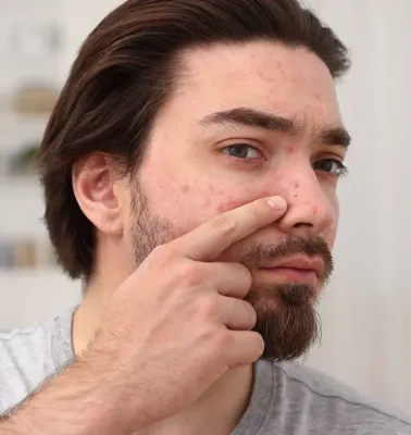 24 Question and Answers Essential to Understand the Causes and Treatments of Men’s Acne