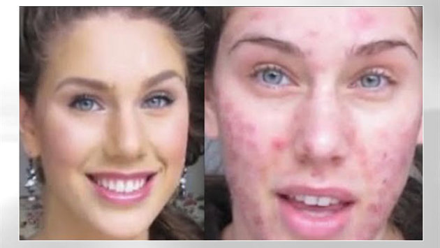 AcnEase Provided A Natural Solution To Treating Cassandra Bankson s 