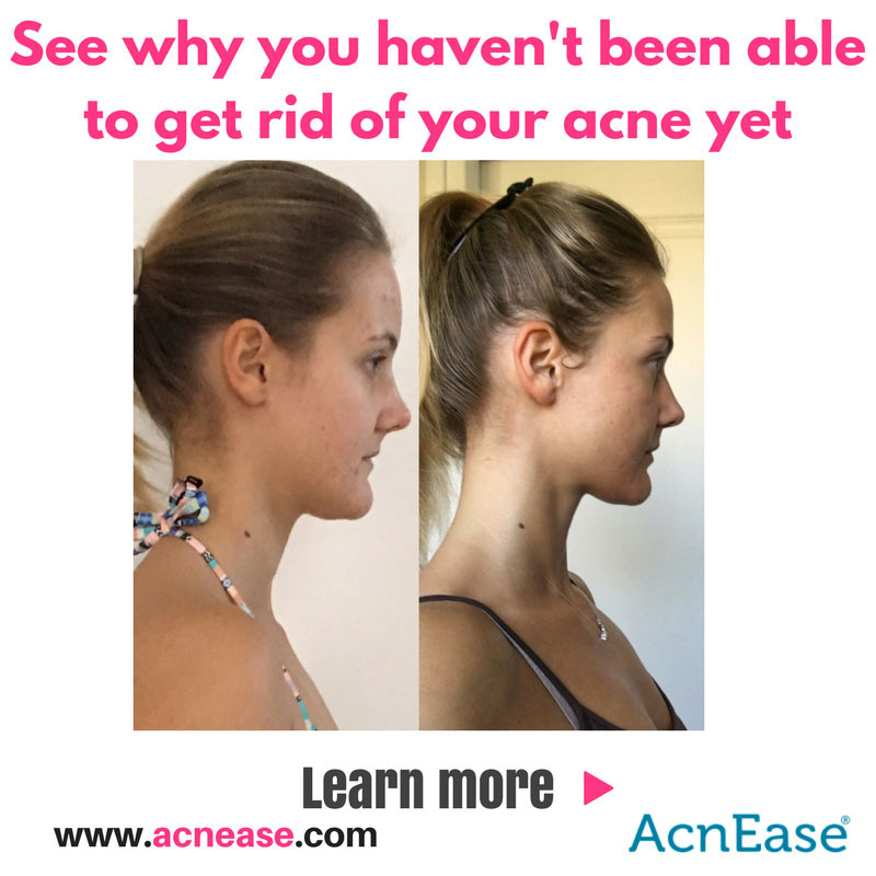 If You Really Want to Get Rid of Acne, Start Doing These Two Things Now 