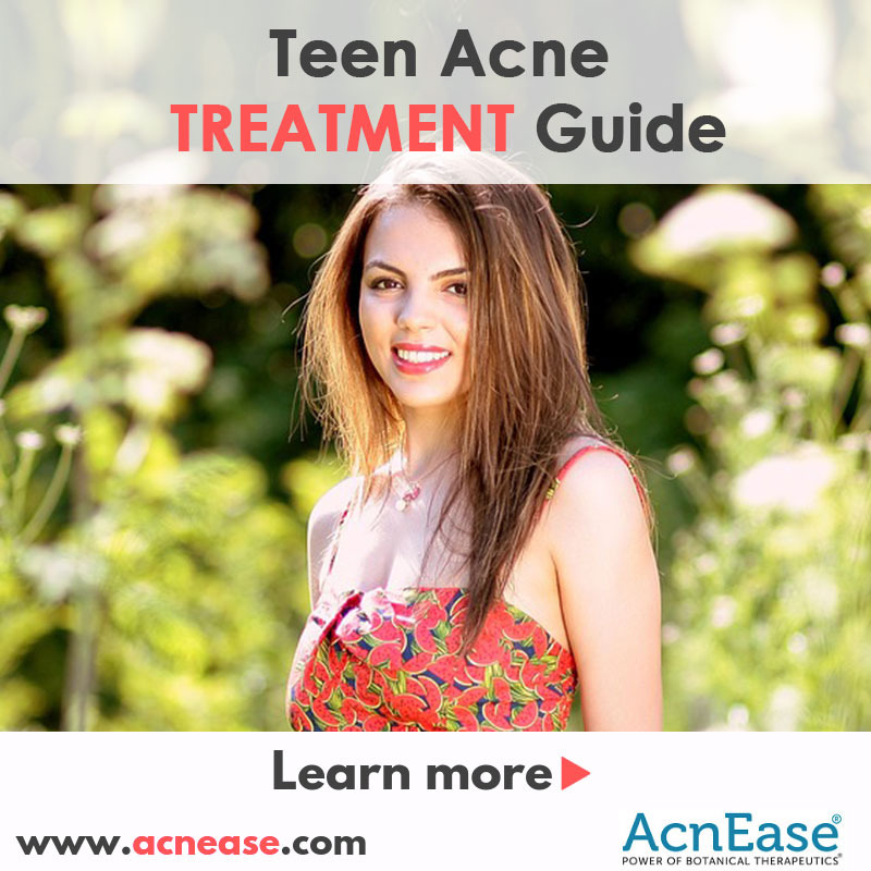 Teen Acne Treatment Guide