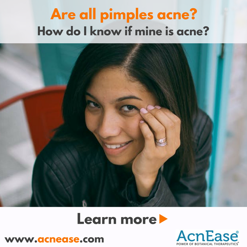 Are all pimples acne? How do I know if mine is acne?