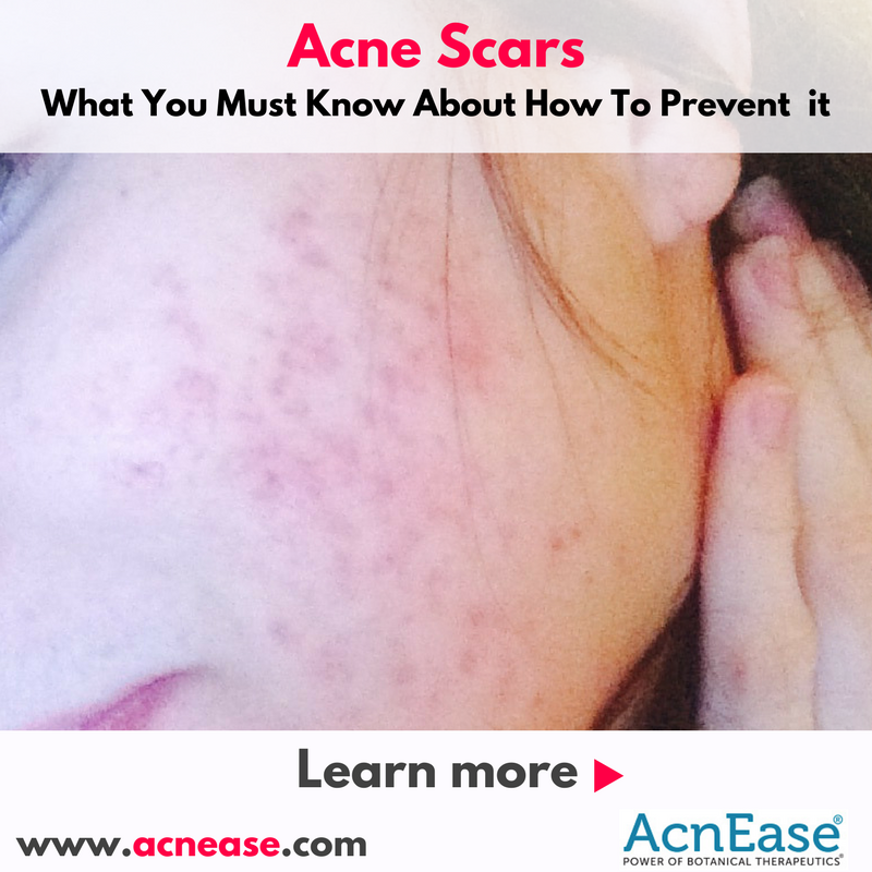 What You Must Know About How To Prevent Acne Scars