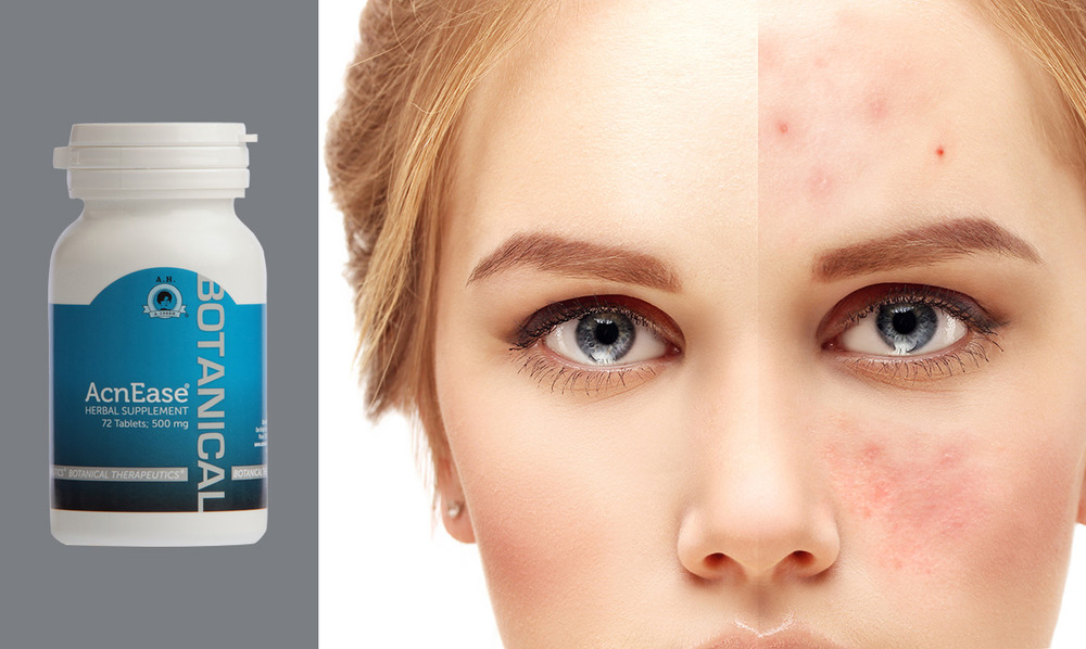  Have Chroic Acne?  Two ingredients you  do NOT want to useand ONE you DO!