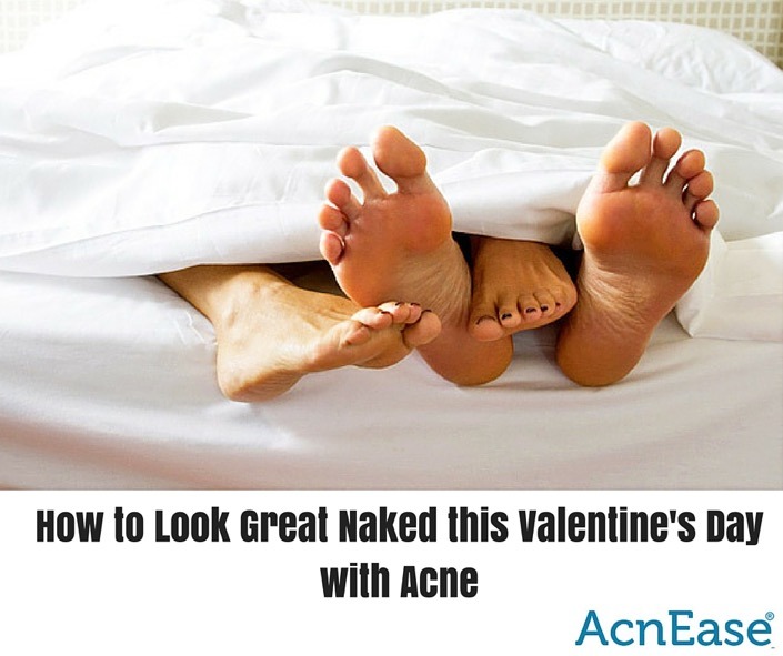 How to Look Great Naked this Valentine’s Day with Acne
