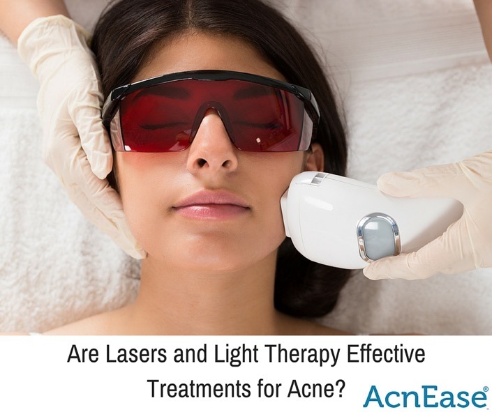 Are Lasers and Light Therapy Effective Treatments for Acne?