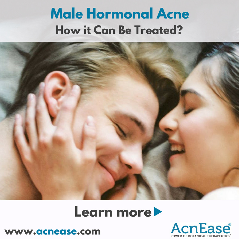 Male Hormonal Acne and How it Can Be Treated