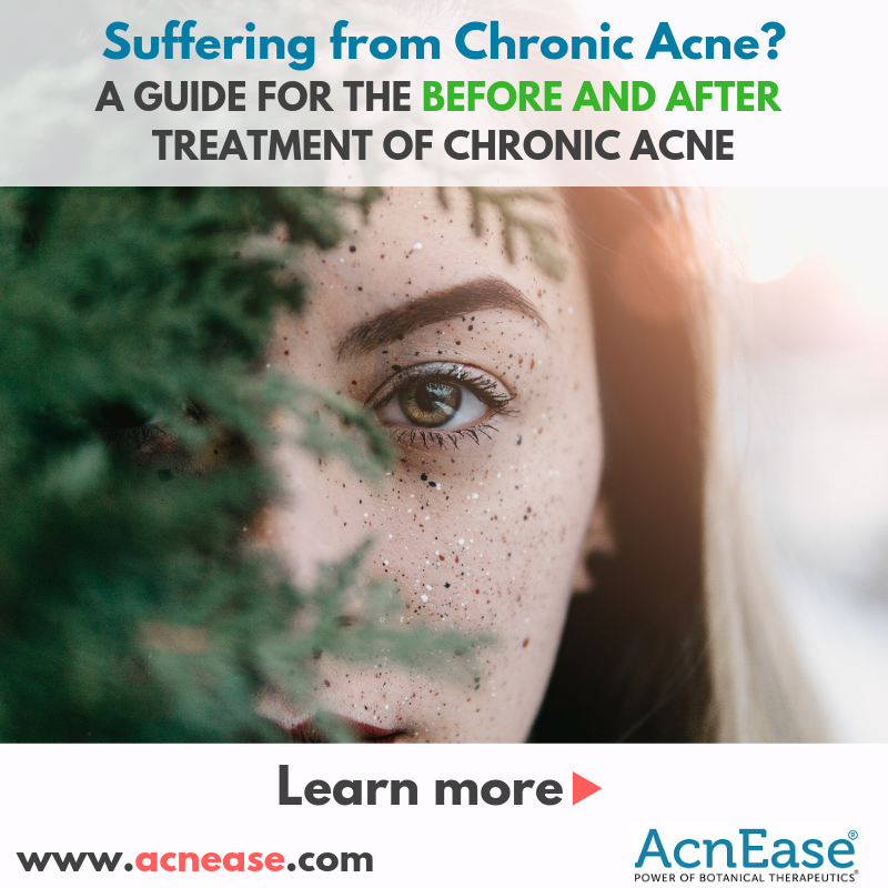 Guide for the before and after treatment of chronic acne