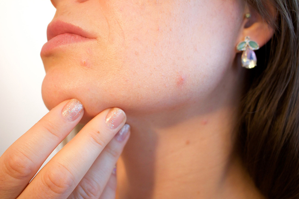 When It Comes To Acne-Prone Skin, What Are The   Do’S And Don’Ts?