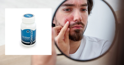 Quick Guide to Preventing and Treating Acne Scars