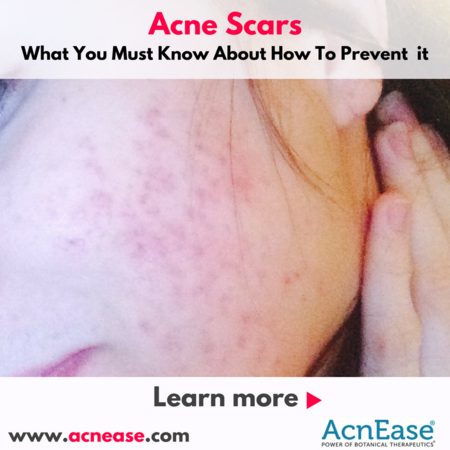 What You Must Know About How To Prevent Acne Scars | Blog What You Must Know About How To Prevent Acne Scars | Blog