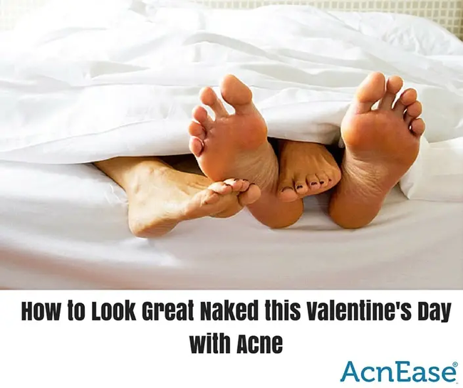 How to Look Great Naked this Valentine’s Day with Acne