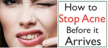 How to Stop Acne Before it Arrives