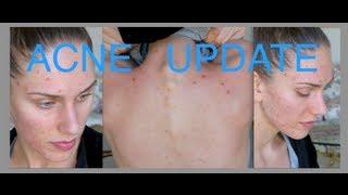 Acne Update For Acne Awareness Month! Sunscreen, Skincare Routine, Summer & Herbal Supplements!